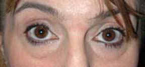 Eye Lift - Patient 2 - Before